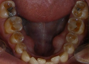 acid erosion from untreated acid reflux disease. Image from http://allentxdentist.com/acid-reflux-disease-may-lead-to-erosion-of-teeth/
